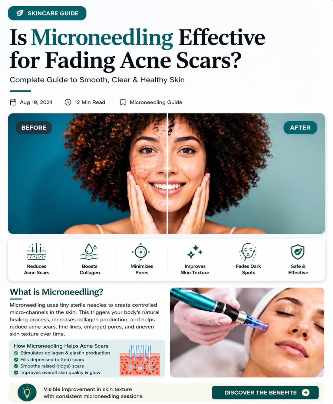 Microneedling for acne scars treatment in Pakistan - collagen induction therapy guide by Aura Aesthetics Care